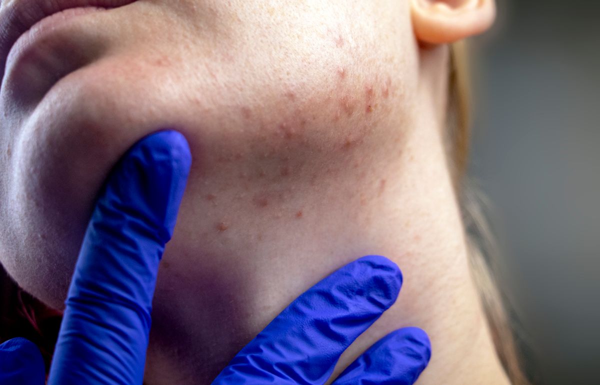 Acne on the chin: demodecosis tick on the skin of a girl's face. Patient at the appointment of a dermatologist. Problem skin and beauty concept.